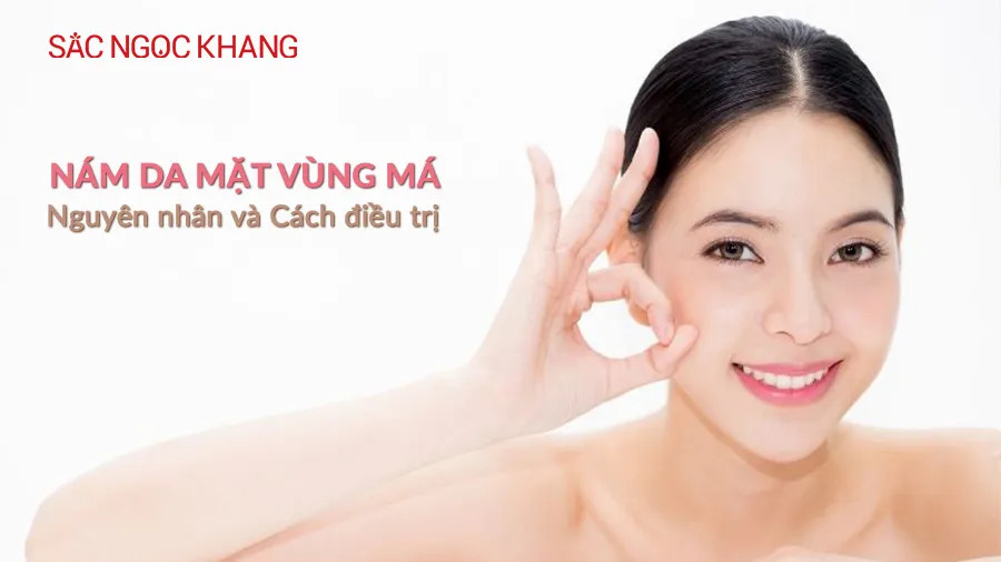 Nám da mặt vùng má: “Nỗi đau” của phụ nữ tuổi 30