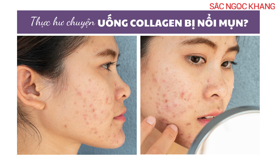 Thực hư chuyện uống collagen bị nổi mụn