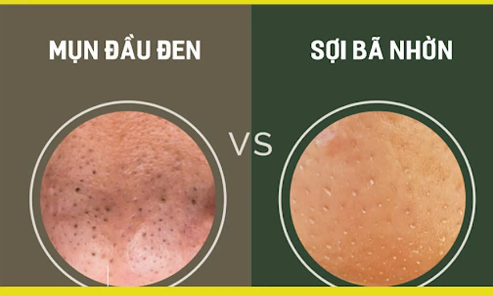 Phân Biệt Mụn Đầu Đen và Sợi Bã Nhờn: Nguyên Nhân và Cách Điều Trị